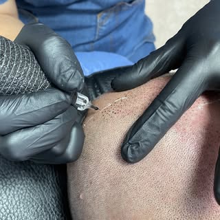 In Scalp Micropigmentation (SMP), dot placement is one of the most important factors in creating a n