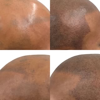 Alopecia can cause patchy hair loss, thinning, or complete baldness, which often affects a person’s 