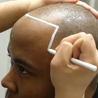When planning your scalp micropigmentation hairline, the goal is to create balance and realism rathe