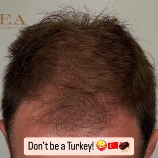 Patients going overseas for hair transplants are usually told they need much larger procedures than 