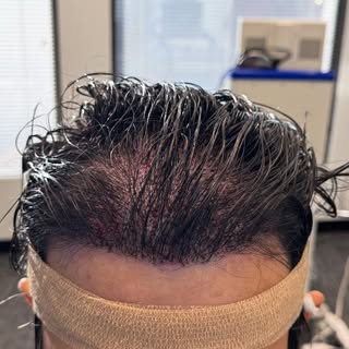 Have you ever wondered why “influencers” do not post videos of their Turkey hair transplants after a