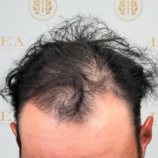 🇺🇸Proudly made in the USA 🇺🇸 There is no need to risk getting a hair transplant in a foreign cou