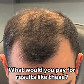 Don’t be a Turkey! 🇹🇷🦃🤣Come see what ILEA can do for you. We have medically proven hair growth s