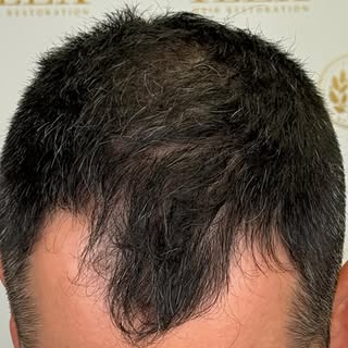 If you have been considering a hair transplant, the time to call is now! Special summer pricing too 