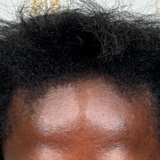 Before and after 6 months after 3,000 graft FUE hair transplant. Loving her results! Part line on he