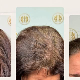Thinning hair can be caused by various factors—genetics, hormonal fluctuations, stress, or prolonged