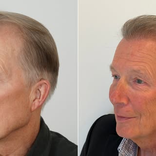 Age is just a number—but confidence is timeless.

Meet our incredible 72-year-old patient, just 6 mo