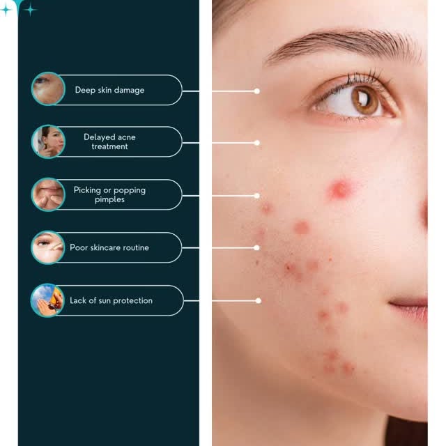Acne is more than just skin deep! Understand the real reasons behind breakouts and take the right st