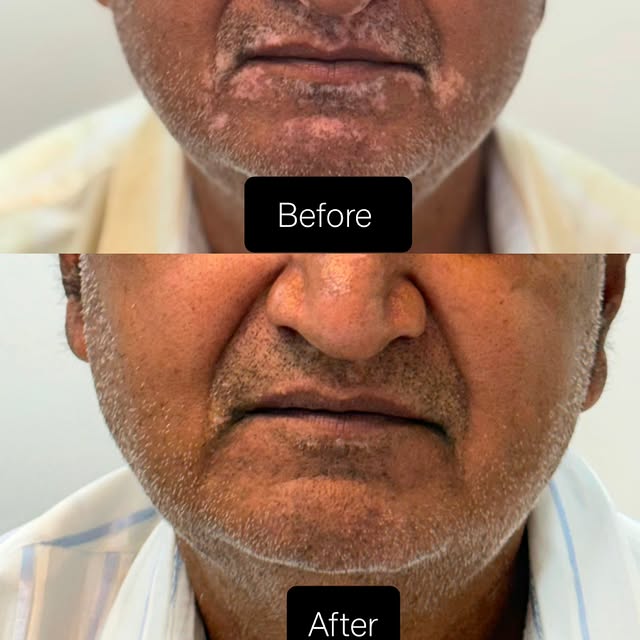 Your acne isn't always random—but its location alone canot diagnose a health problem. It can offer c