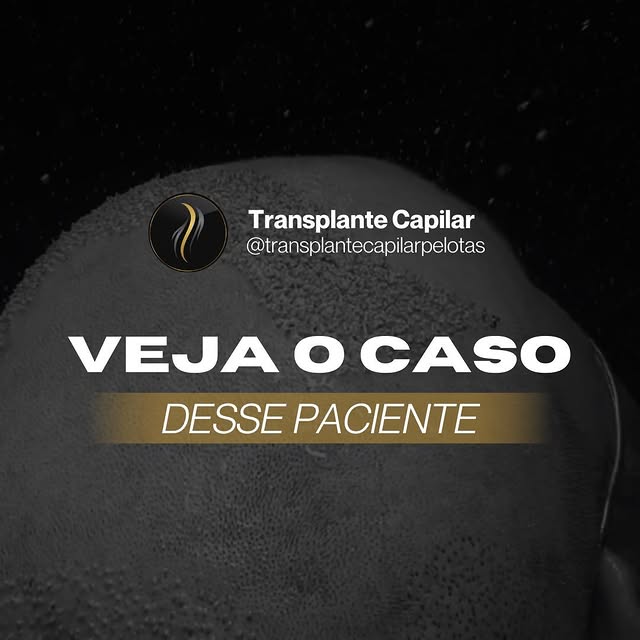 Foram 9 mil fios transplantados!😱

A coroa que era sua grande queixa foi totalmente preenchida e ai