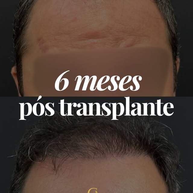 Em apenas 6 meses de transplante, esse é apenas 50% do resultado!💥

O que você achou dessa transfor