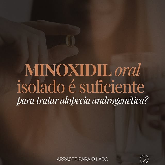 Você sabia que o minoxidil oral sozinho não é o suficiente para tratar a calvície de forma definitiv