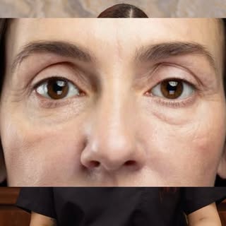Do you sometimes at destination weddings wake up with puffy undereye? 
Usually people with cholester