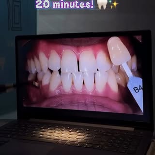 ✨ Brighten your smile and boost your confidence!

Over time, coffee, tea, and everyday habits can du