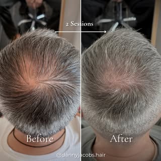 Before / After - 2 sessions.

Crown density SMP on a client with naturally grey hair. The goal was s