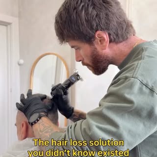 Scalp micropigmentation. A cosmetic tattoo procedure that replicates the look of natural hair follic