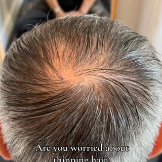 Are you worried about thinning hair?

Density SMP can give the appearance of fuller and thicker hair