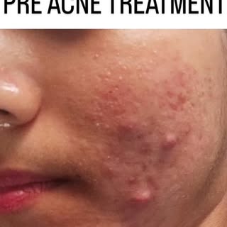 Suffering with ACNE ??? We have one stop solution 🛑 
✨ Clear skin starts with the right treatment. 