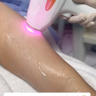 Smooth skin, less hassle ✨
Say goodbye to frequent shaving and waxing with Laser Hair Reduction. Enj