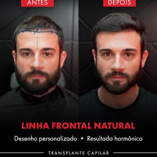 06 meses de cirurgia 
Reconstrução total das entradas, recessos temporais e área da coroa

Compromis