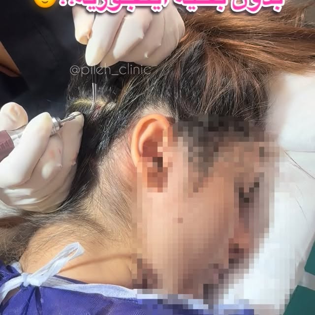 ⁨	برداشت تار به تار مو برای #میکروکاشت ابرو بدون بخیه و جراحی🤫🫣

بفرست برای اون دوستت که از بخیه ک
