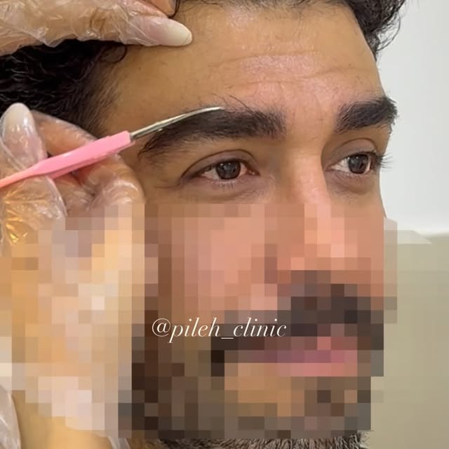 ⁨	۱۴روز بعد کاشت ابرو جهت اصلاح تشریف اوردن
به به🤌😌 کاملا طبیعی و مردانه
مشاوره ورزرو نوبت: 091207