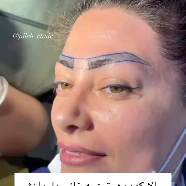 ⁨	از ابرویی که فقط یک تتوی محو از آن باقی مانده بود، تا ابروهایی با تار موی طبیعی و دائمی😌
مشاوره و