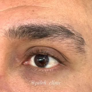 زیبایی واقعی یعنی ابروهایی که هیچ‌کس متوجه کاشت بودنشون نشه
کاشت ابرو برای آقایان عزیز همینقدر طبیعی