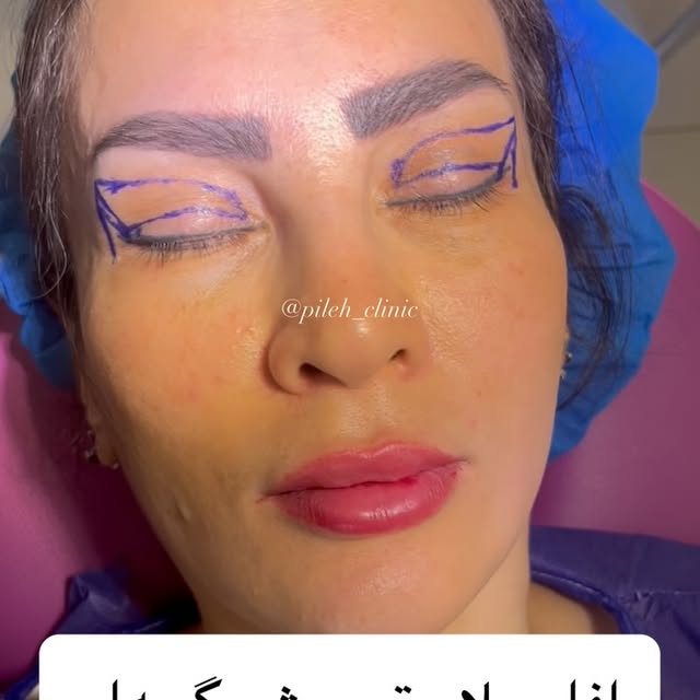 بلفاروپلاستی cat eye با بخیه لیزری
مشاوره: 09120719901☎️

#بلفارو #بلفاروپلاستی #لیفتابرو #لیفتشقیقه
