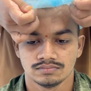 Hair Transplantation Transformation: The before & after says it all.

#hairtransformation #hairtrans