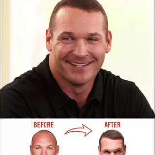 @54Urlacher pulled up to a drive thru after his FUE hair restoration and a girl told him he looked l