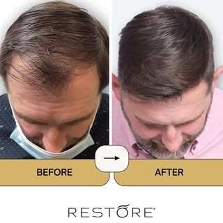 100% natural, undetectable results. No one will know, but you!

#hair #balding #hairtransformation #