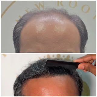 Precision in every step. 

A successful hair transplant is the result of careful planning, expert ex