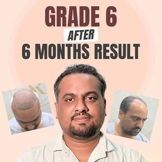 Changing the narrative on Grade 6 hair loss. 

A Grade 6 pattern requires a master plan, precision e