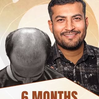 🎉 **6 Months Later... The Transformation Speaks for Itself!** 🎉

From **Grade 6 baldness** to a na