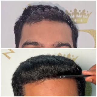 Think a hair transplant is just for the "after" photo? Think again. 

It starts with the design. It 
