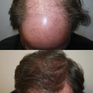 Sometimes just one procedure can change your life.  #Rosanelli #ARTAS #FUE #FUT #hairloss #hairresto