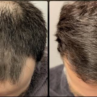 Want to refresh your look? Dr. Rosanelli is the hair restoration expert for you. Having done over 10