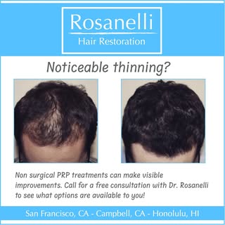 Noticeable thinning?
Non surgical PRP treatments can make visible improvements. Call or Click the Li