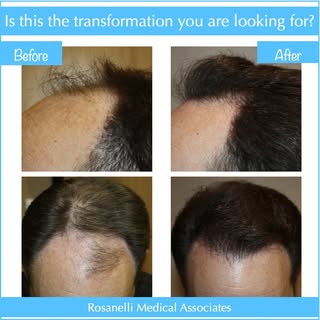 Patient results after 2 strip sessions using 3,354 grafts total. If this is the transformation you a