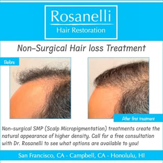 If you are looking for a denser appearance for you hair, SMP may be a quick improvement with no down