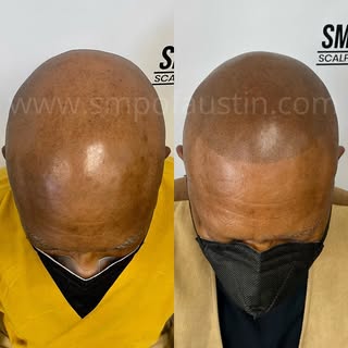 👏🏼👏🏼👏🏼👏🏼

#scalpmicropigmentationaustin #scalpmicropigmentationtexas #smpaustin #smpatx #smp