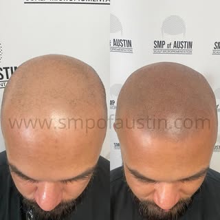 💥BOOM💥 😎 

#scalpmicropigmentationaustin #scalpmicropigmentationtexas #smpaustin #smpatx #smpwaco