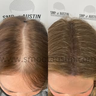 What thinning? 😉

#scalpmicropigmentationaustin #scalpmicropigmentationtexas #smpaustin #smpatx #sm