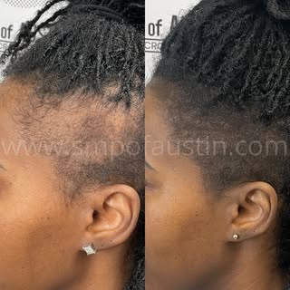 Say hello to your solution for #tractionalopecia Come see what SMP can do for you! 
🫶🏼

#scalpmicr