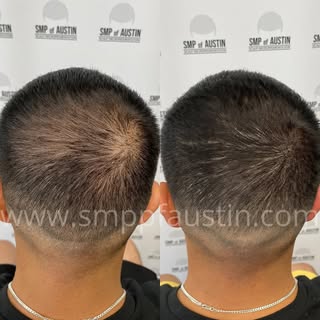 Fantastic density fill in. 👍🏼

#scalpmicropigmentationaustin #scalpmicropigmentationtexas #smpaust