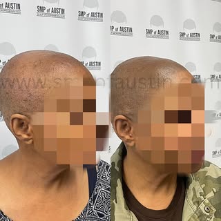If “Bold and Beautiful” was a hairstyle
✨✨✨✨

#scalpmicropigmentationaustin #scalpmicropigmentationt
