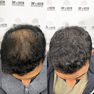 Density for the win!
🙌🏼🙌🏼🙌🏼🙌🏼

#scalpmicropigmentationaustin #scalpmicropigmentationtexas #s