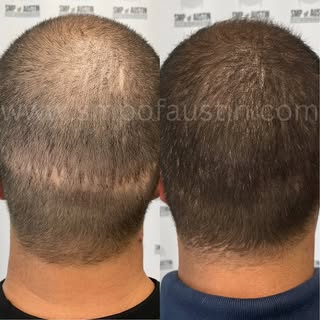 Scar 🔪today, gone tomorrow 🚀

This client came in with a jagged FUT scar from multiple hair transp