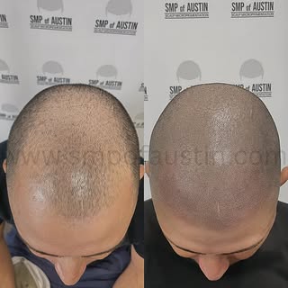 Oh, so seamless! 👏🏼👏🏼 

#scalpmicropigmentationaustin #scalpmicropigmentationtexas #smpaustin #s